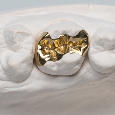 Gold-Inlay
