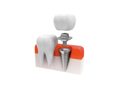 Zahnzusatzversicherung: Implantat- & Kronenversorgung